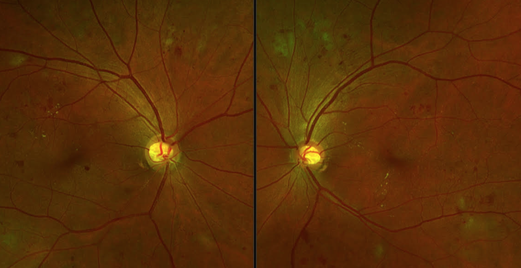 optos diabetic retinopathy