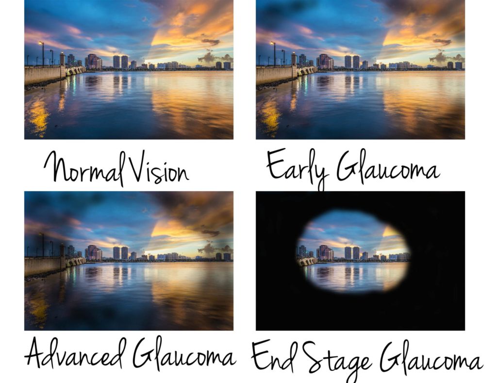 gluacoma side vision loss
