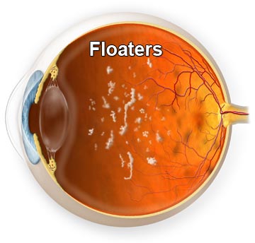 Vitreous Floaters
